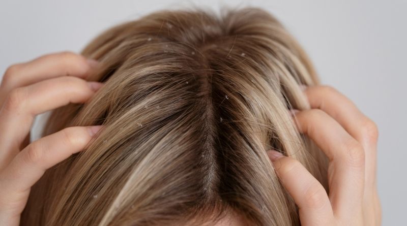 Top Home Remedies for Dandruff: Natural Solutions for a Flake-Free Scalp
